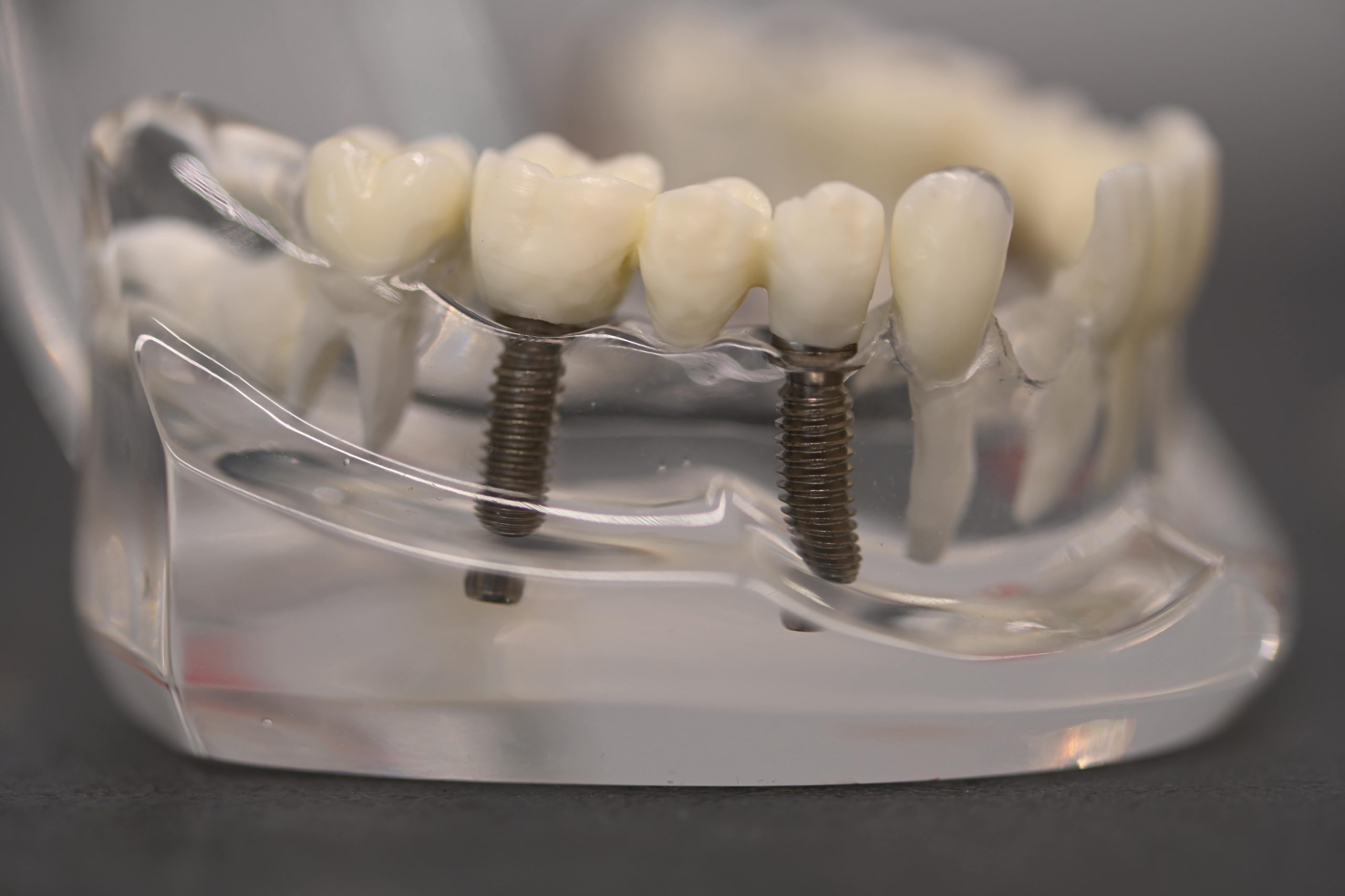 Dentale usluge Zagreb - Mala Mlaka - Implantologija