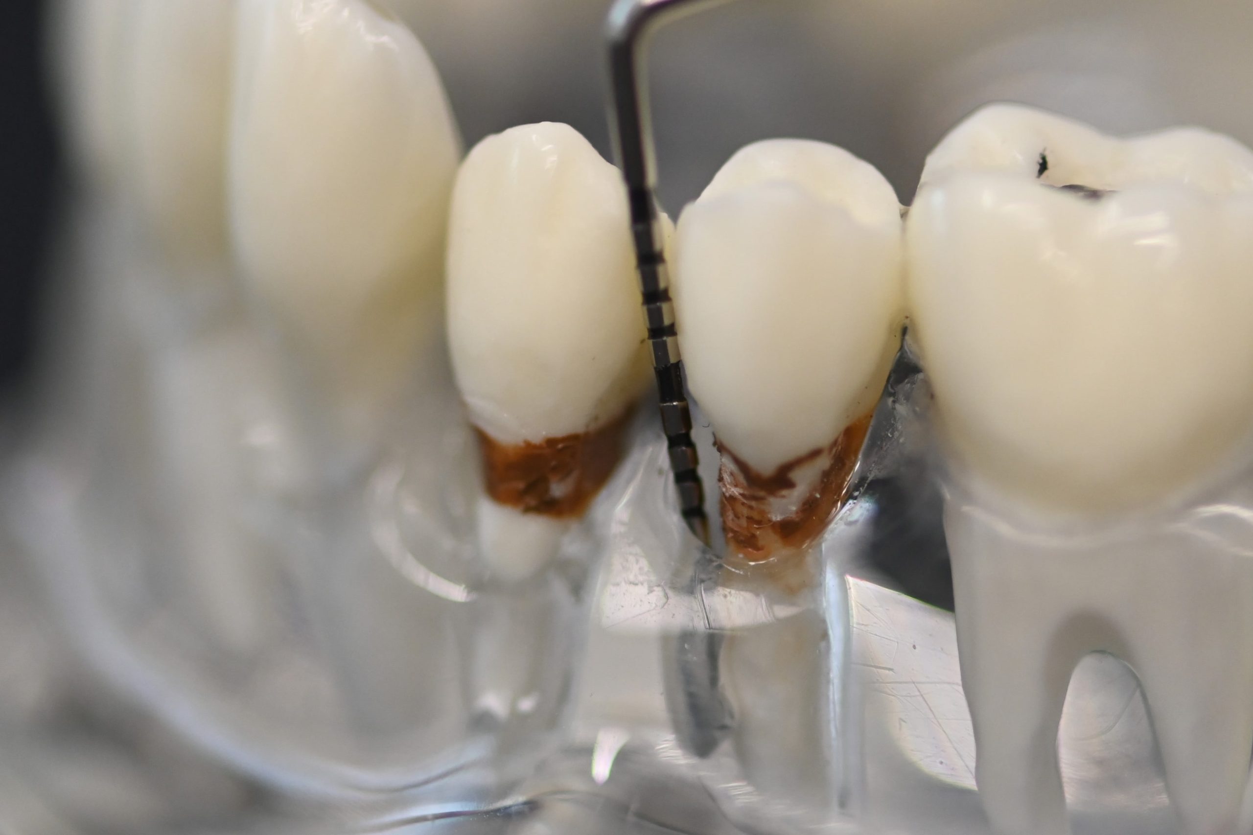 Dentale usluge Zagreb - Mala Mlaka - Parodontologija