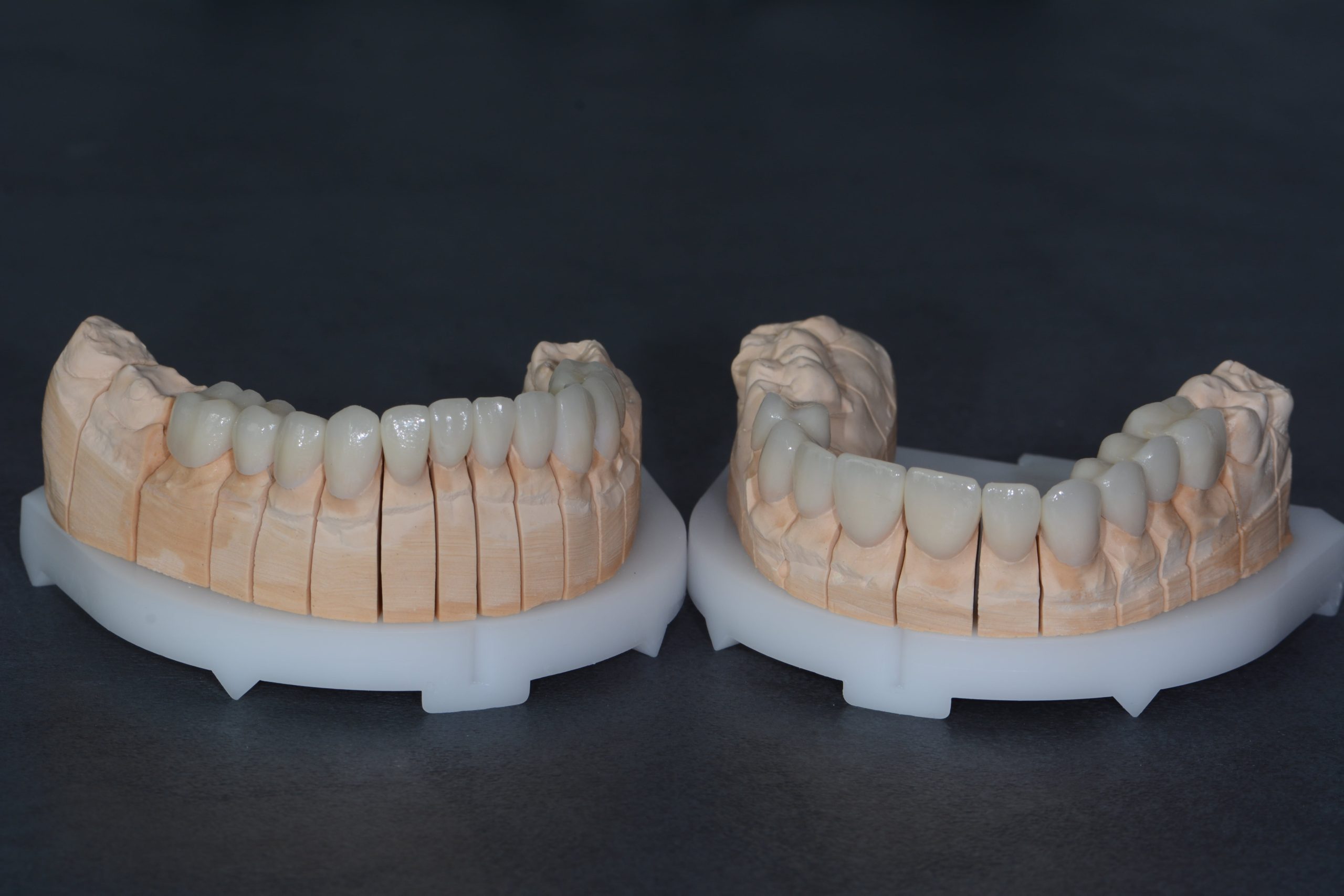 Dentale usluge Zagreb - Mala Mlaka - Protetika